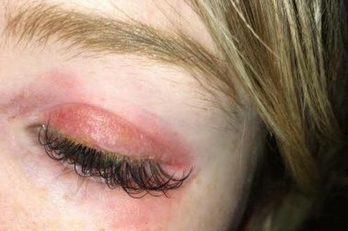 Pictures of Allergic Reaction to Eyelash Extensions